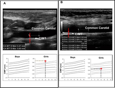 carotid intima media thickness measurement|carotid intima media thickness guidelines.